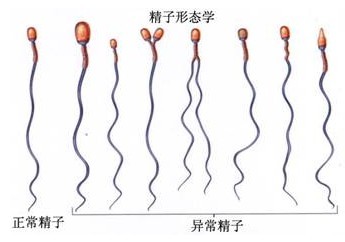 精子畸形